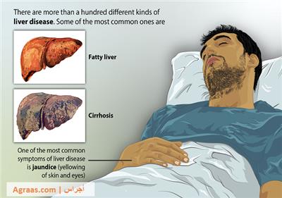 تليف الكبد الأعراض والأسباب